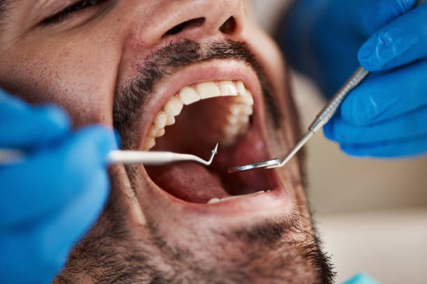 Best Dentist for Tooth Abscess  in Big Lake, TX